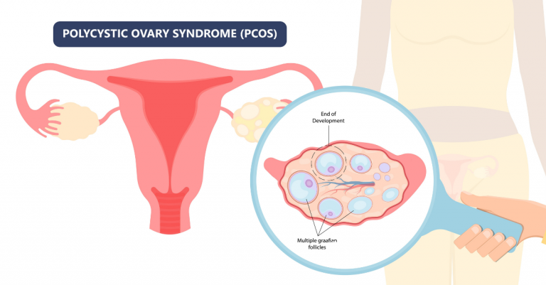 PCOS-Tryon-Medical-Partners
