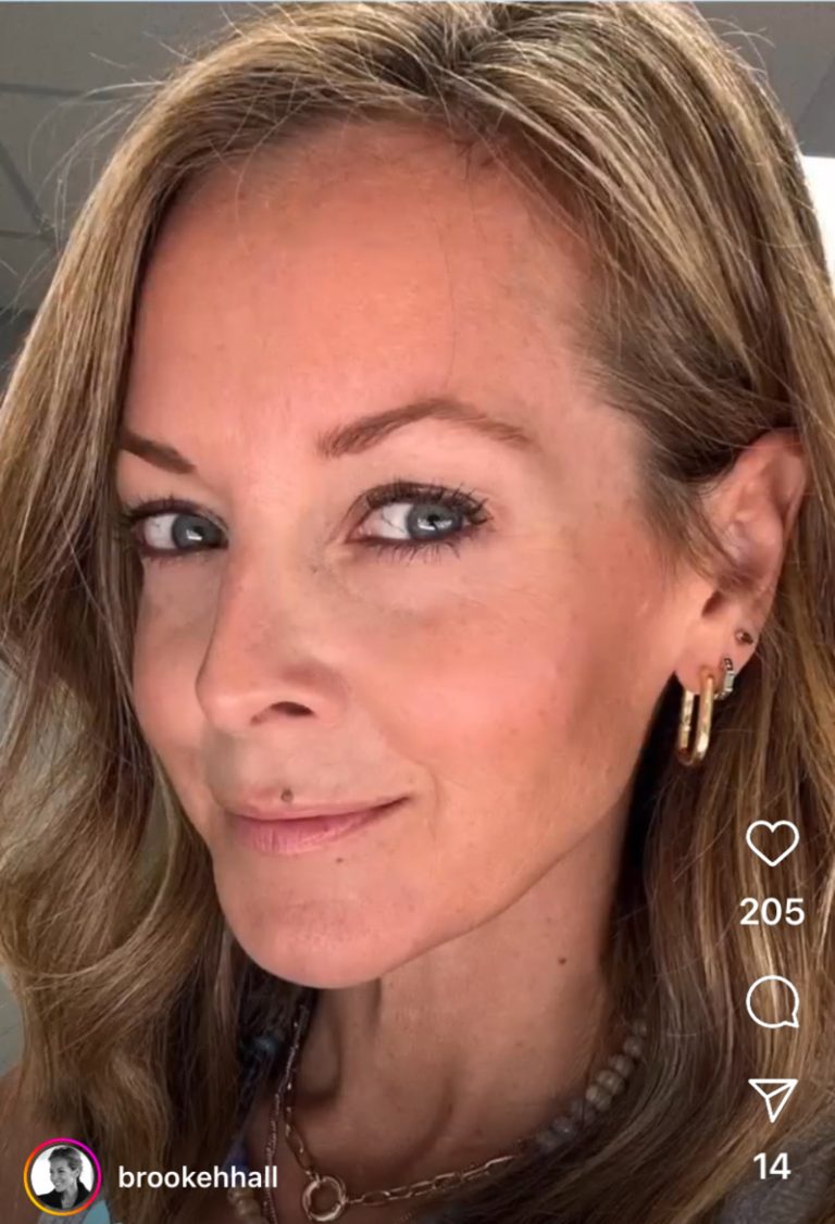 after-botox-crows-feet_res-1